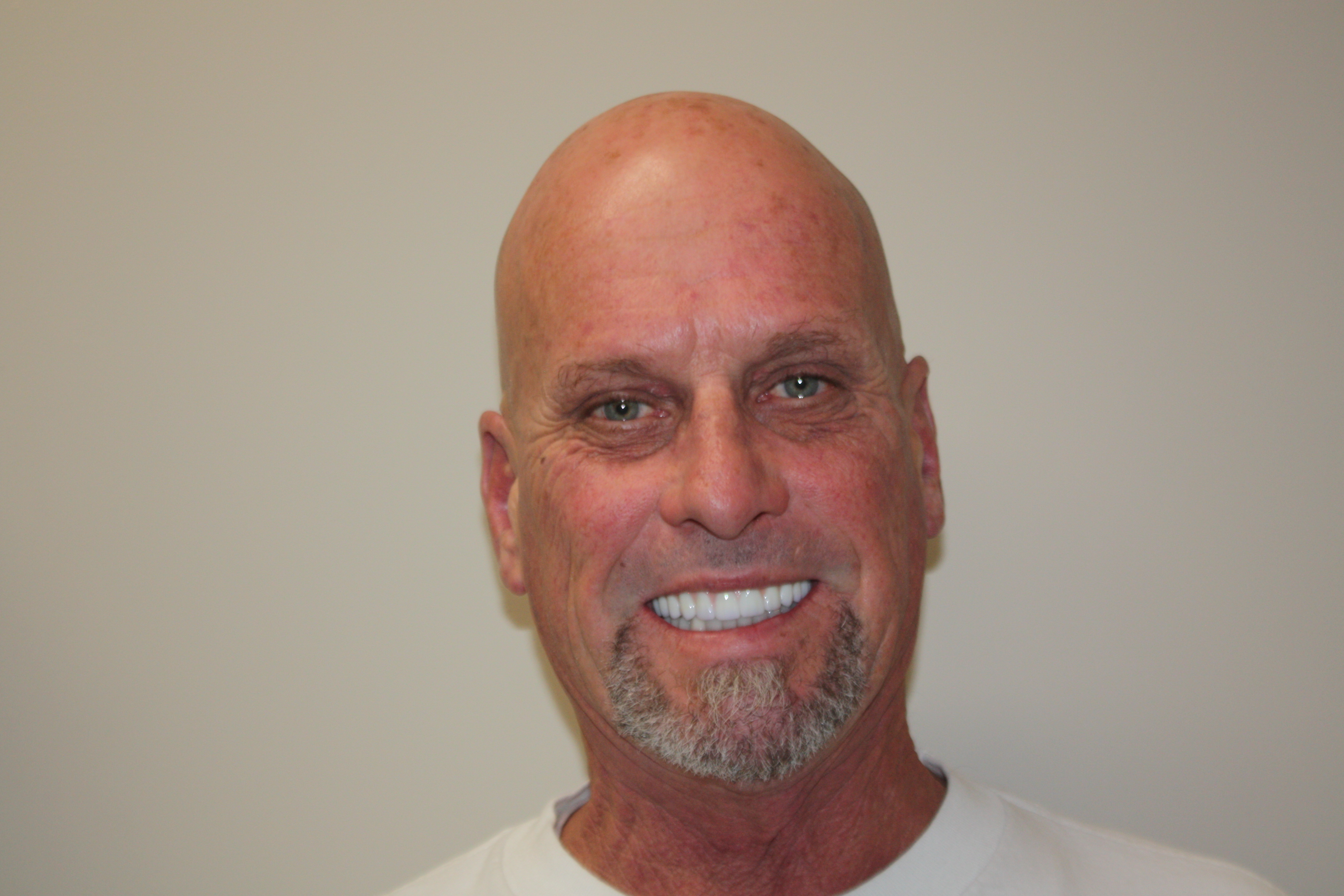 After photo of Andrew's smile makeover at North County Cosmetic and Implant Dentistry in Vista, CA