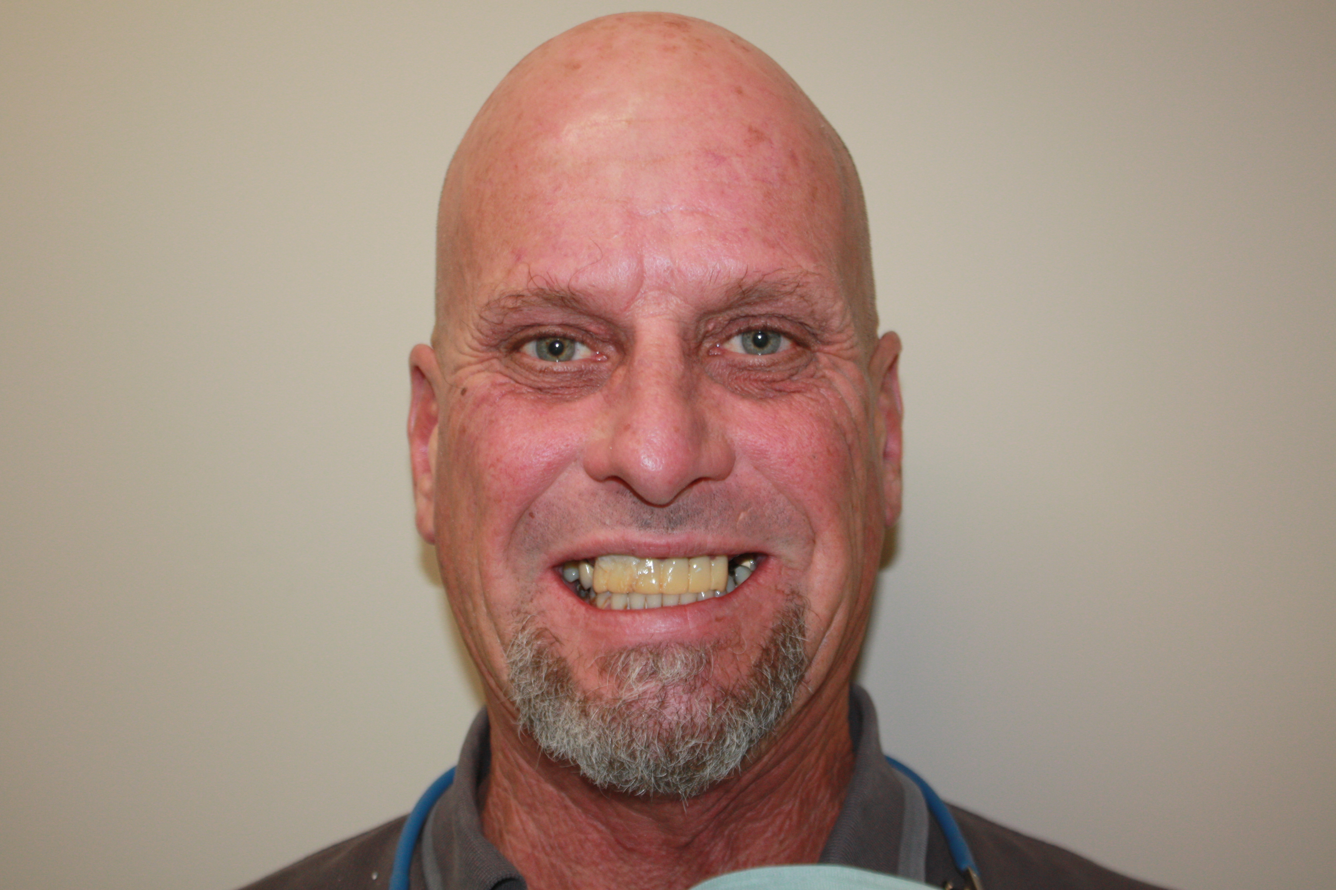 Before photo of Andrew's dental treatment at North County Cosmetic and Implant Dentistry in Vista, CA