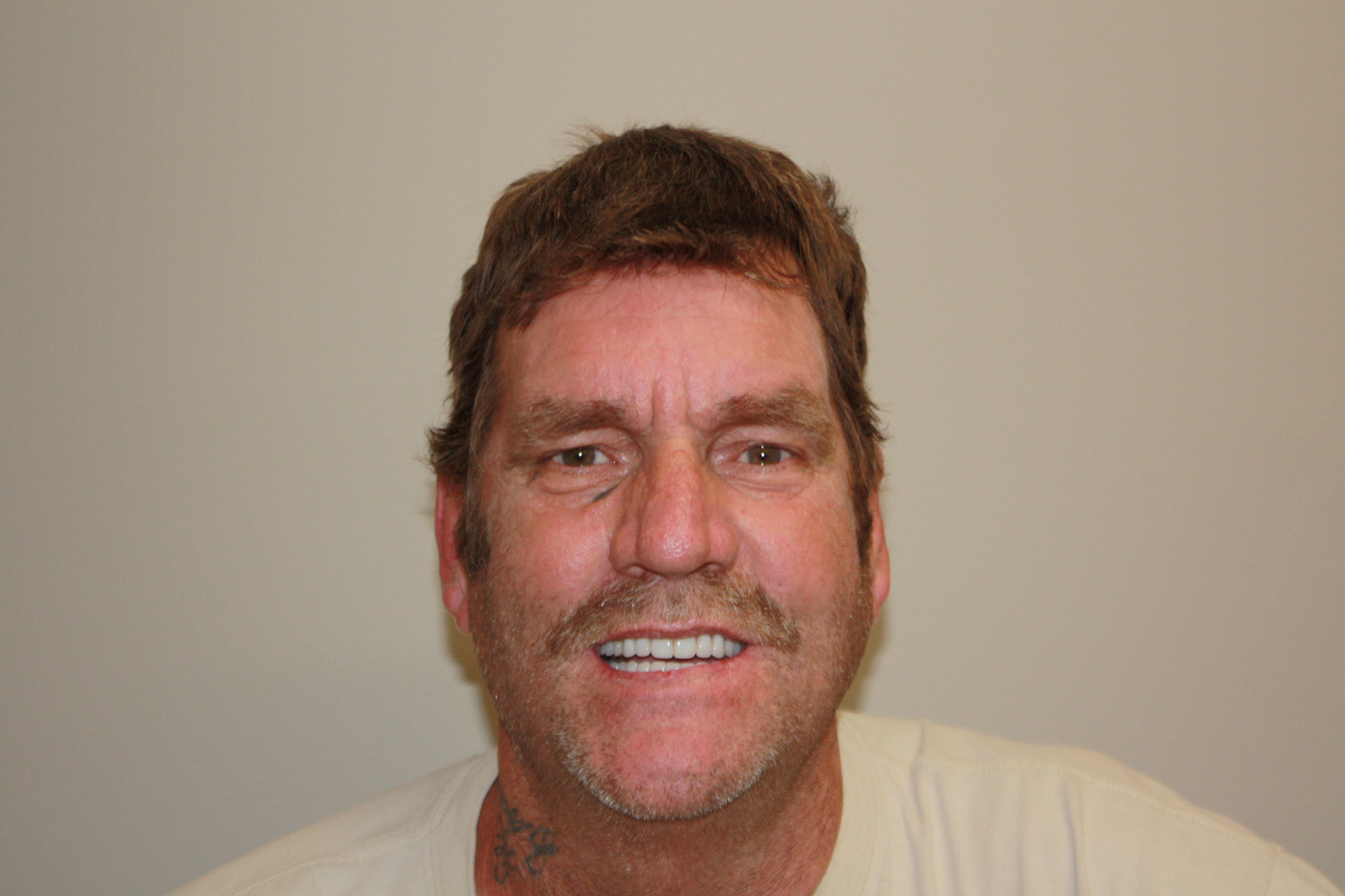 After photo of Craig's dental transformation at North County Cosmetic and Implant Dentistry in Vista, CA