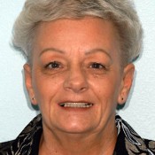 Before photo of dentures transformation at North County Cosmetic and Implant Dentistry in Vista, CA