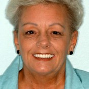 After photo of dentures transformation at North County Cosmetic and Implant Dentistry in Vista, CA