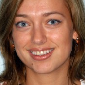 After photo of Helena’s smile makeover at North County Cosmetic and Implant Dentistry in Vista, CA