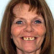 Before photo of dental implants treatment at North County Cosmetic and Implant Dentistry in Vista, CA