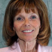 After photo of dental implants at North County Cosmetic and Implant Dentistry in Vista, CA