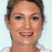 Before photo of Jaime’s dental transformation at North County Cosmetic and Implant Dentistry in Vista, CA