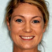 After photo of Jaime’s smile makeover at North County Cosmetic and Implant Dentistry in Vista, CA