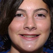 Before photo of Julia’s dental transformation at North County Cosmetic and Implant Dentistry in Vista, CA