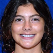 After photo of Julia’s dental treatment at North County Cosmetic and Implant Dentistry in Vista, CA