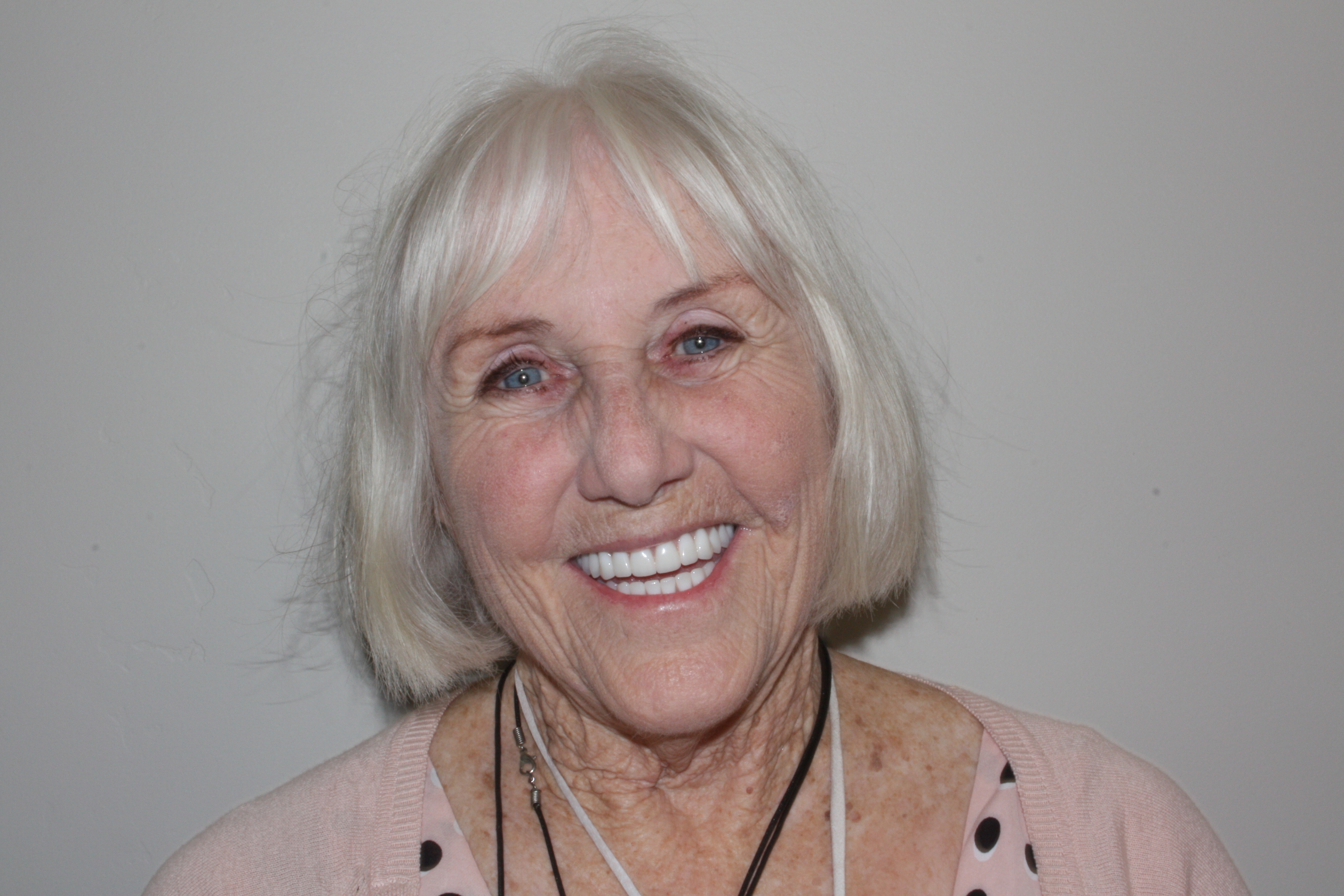 After photo of Kay's cosmetic dental work at North County Cosmetic and Implant Dentistry in Vista, CA