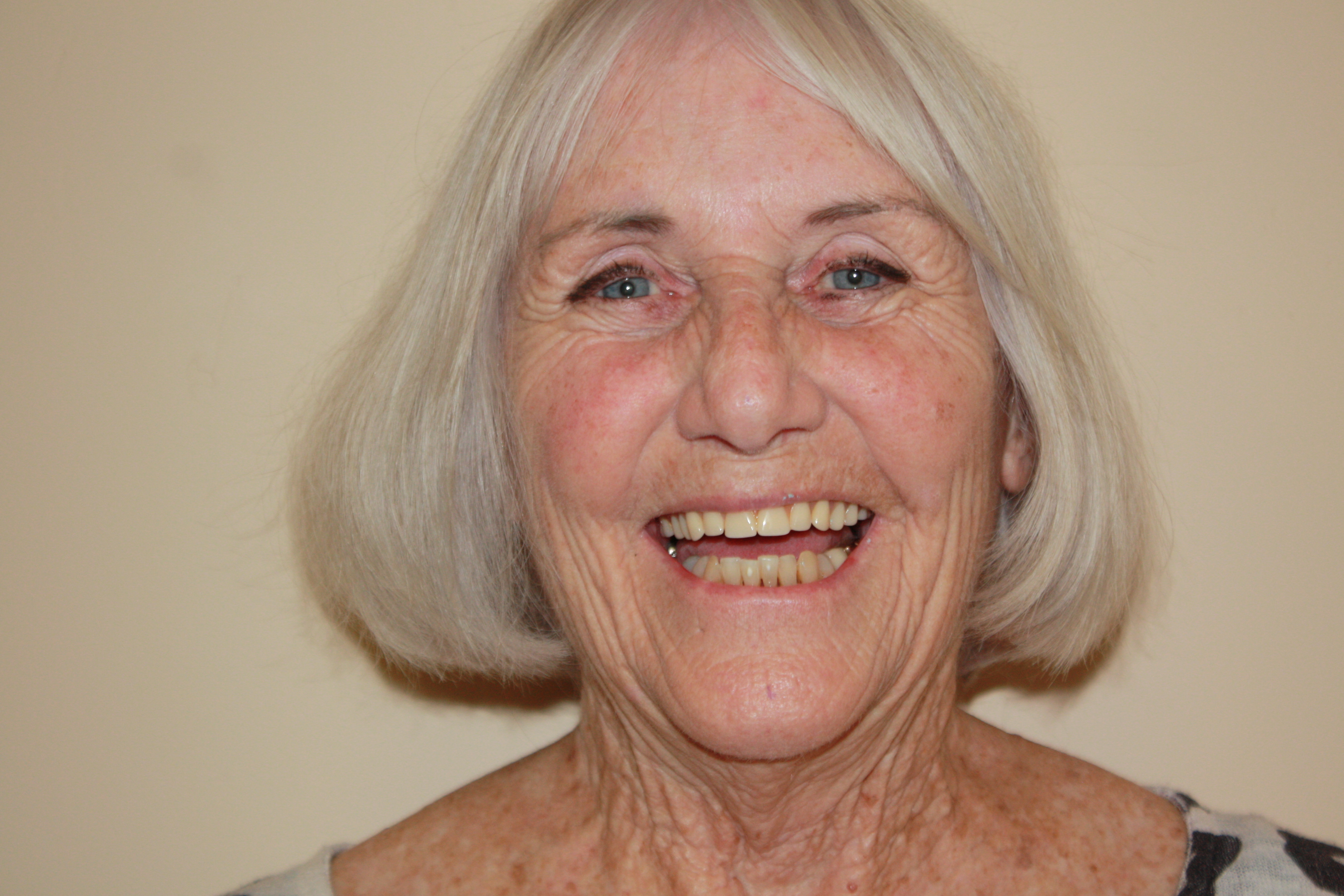Before photo of Kay's dental makeover at North County Cosmetic and Implant Dentistry in Vista, CA