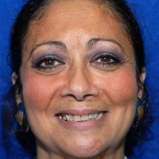 Before photo of Maissa’s dental transformation at North County Cosmetic and Implant Dentistry in Vista, CA