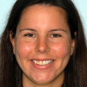 Before photo of nurse’s dental restoration at North County Cosmetic and Implant Dentistry in Vista, CA