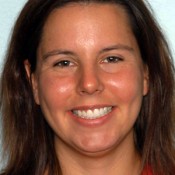 After photo of nurse’s dental treatment at North County Cosmetic and Implant Dentistry in Vista, CA