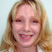 Before photo of smile rejuvenation at North County Cosmetic and Implant Dentistry in Vista, CA