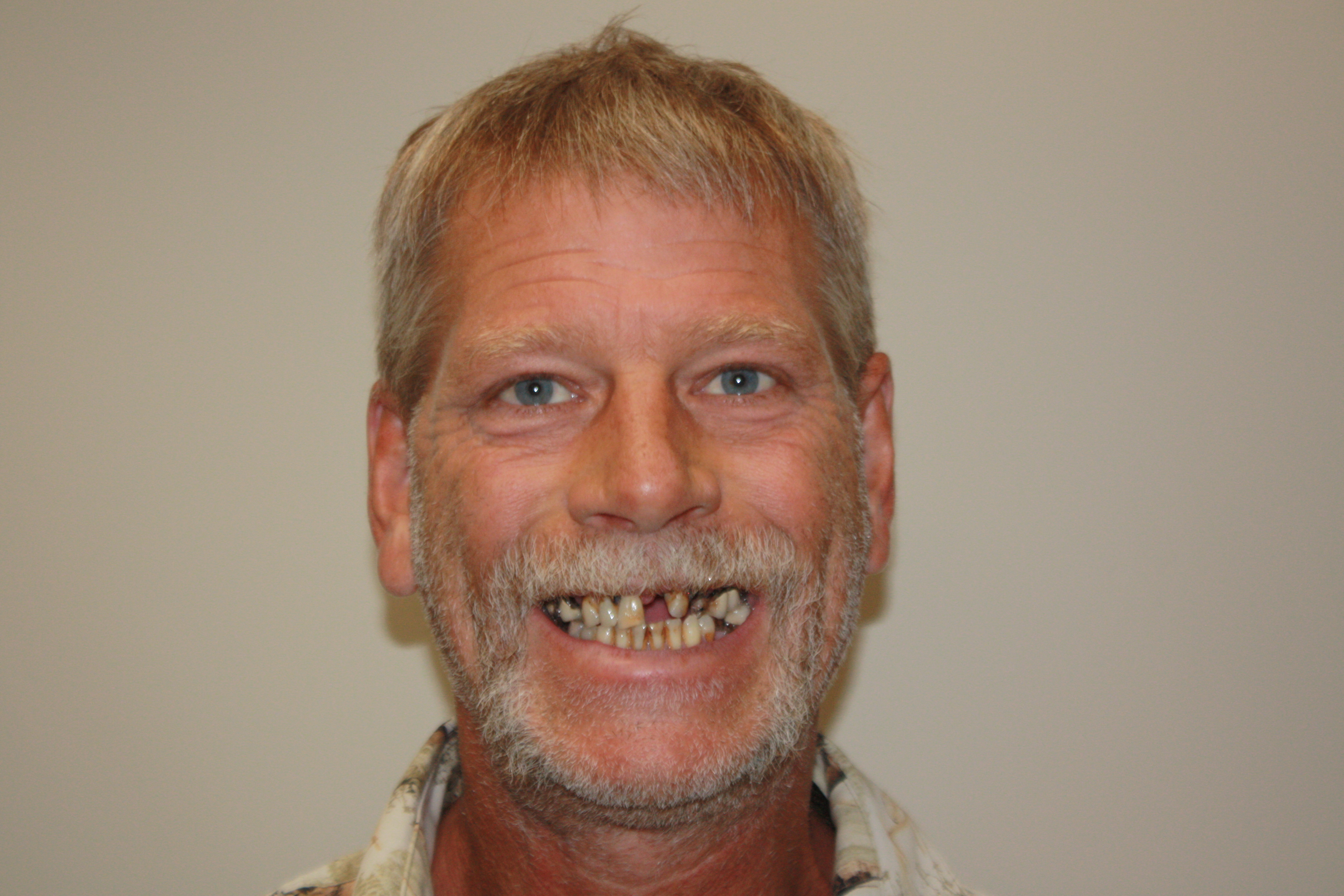 Before photo of Terry's dental procedure at North County Cosmetic and Implant Dentistry in Vista, CA