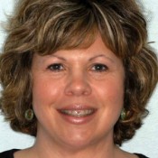 Before photo of gummy smile treatment at North County Cosmetic and Implant Dentistry in Vista, CA