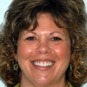 After photo of gummy smile correction at North County Cosmetic and Implant Dentistry in Vista, CA