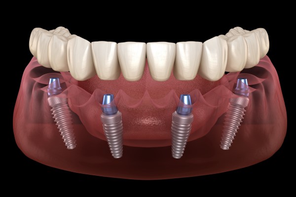 All On      What Is A Fixed Full Arch Restoration?