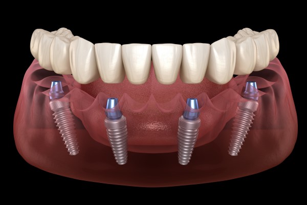 All On      What Is A Fixed Full Arch Restoration?