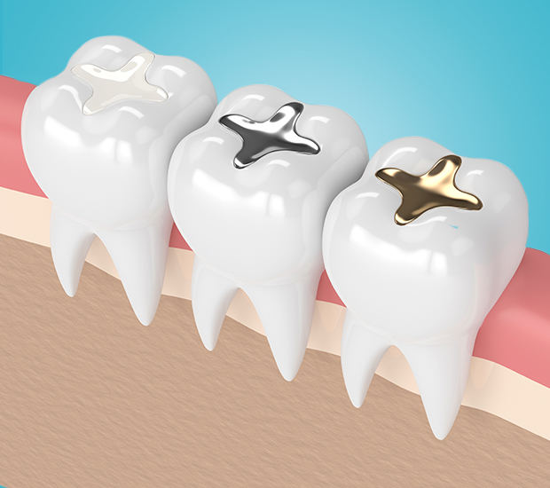 Vista Composite Fillings