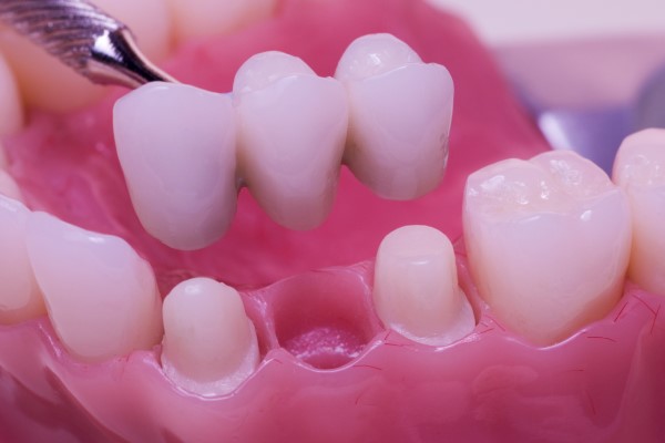 How To Choose Between A Dental Bridge And A Dental Crown