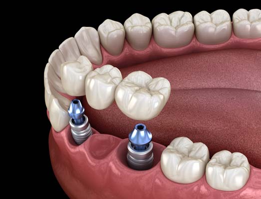 What Are Dental Bridges?