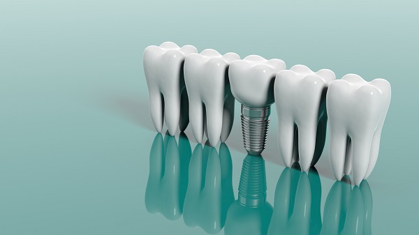 Dental Implant Restoration Vista, CA
