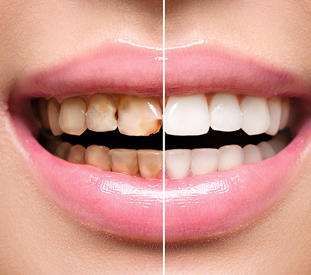 Vista Dental Implant Restoration