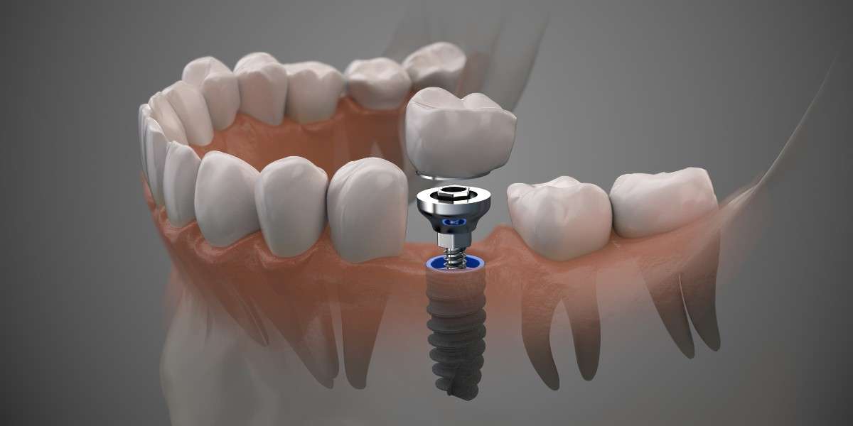 The Longevity Of Dental Implants: A Smile That Lasts A Lifetime