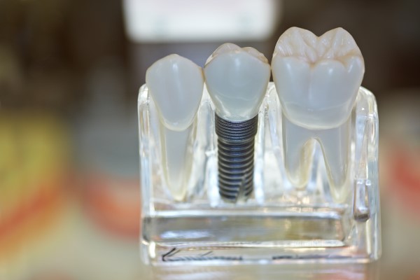 Things To Know About Dental Implants
