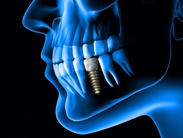 Dental Implants Are Replacement For Lost Teeth