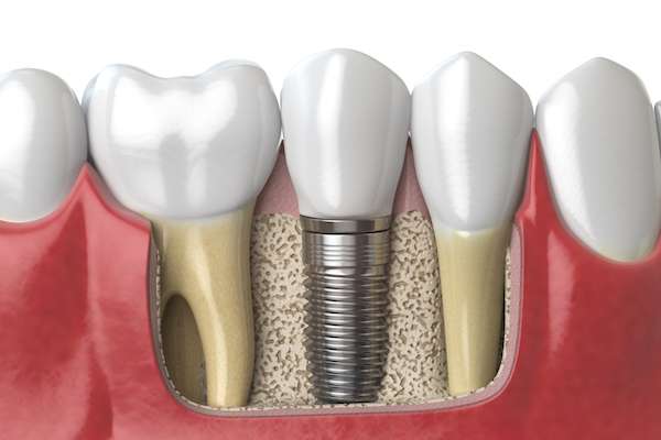 Dental Implants for Replacing Missing Teeth from North County Cosmetic and Implant Dentistry in Vista, CA
