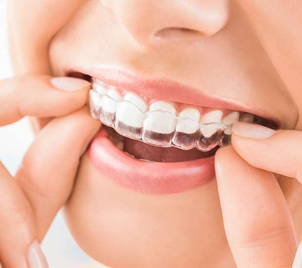 Vista Does Clear Aligner Therapy Really Work
