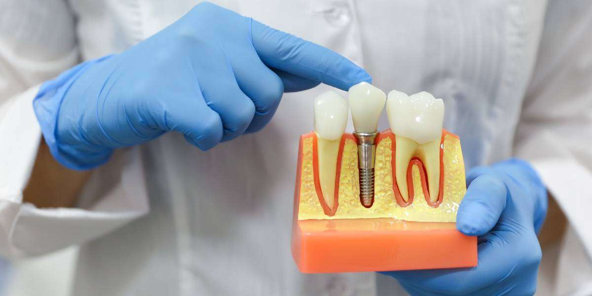 The Crucial Role Of Debridement In Preserving Your Implants