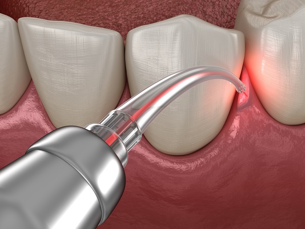 Removing Fillings With The Help Of Laser Dentistry