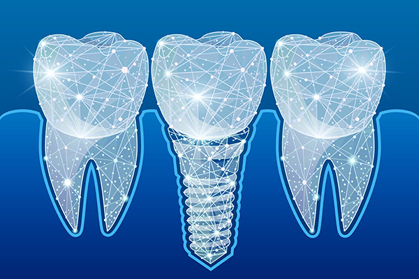 Preventing Complications After Getting Dental Implants from North County Cosmetic and Implant Dentistry in Vista, CA