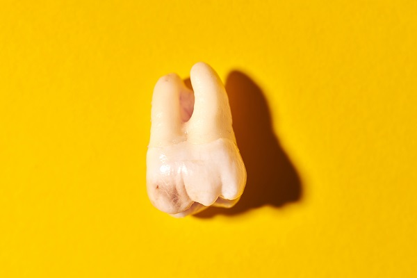 Impacted Wisdom Teeth And Damage To Other Teeth