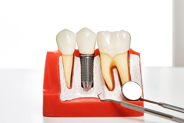 Your Guide to Different Kinds of Dental Implants from North County Cosmetic and Implant Dentistry in Vista, CA