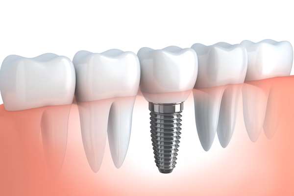 Your Ultimate Guide to Getting Dental Implants from North County Cosmetic and Implant Dentistry in Vista, CA